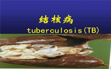 结核防治该工作计划7篇